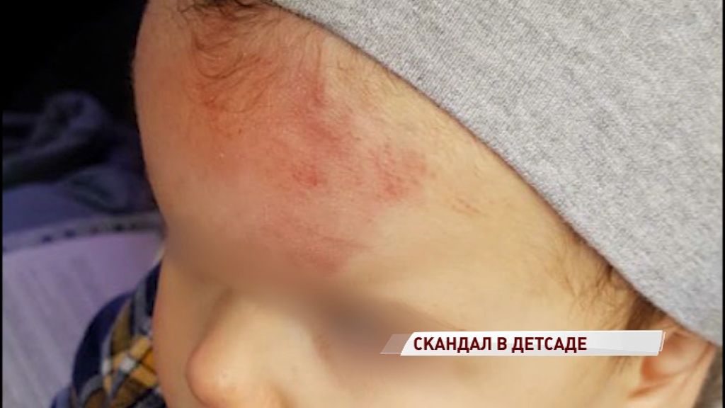 Ребенка из детсада забрали с сотрясением: скандалом заинтересовались в следственном комитете